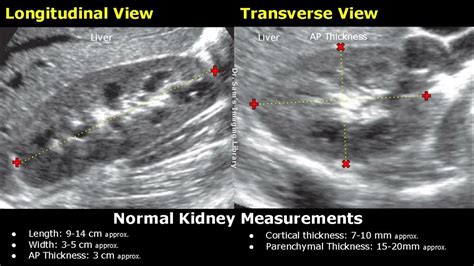 how to measure renal cortical thickness on ultrasound|kidney cortical thinning ultrasound images.